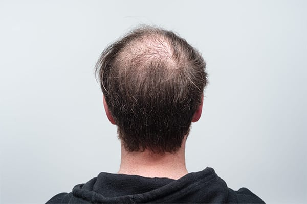 chute de cheveux femme traitement implant capillaire greffe de cheveux paris chirurgien esthetique plasticien paris docteur montoneri