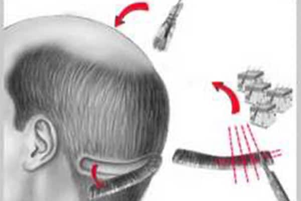 greffe de cheveux fue 7 mois implant capillaire paris chirurgien esthetique plasticien paris docteur sebastiano montoneri greffe de cheveux fue 7 mois implant capillaire paris chirurgien esthetique plasticien paris docteur sebastiano montoneri