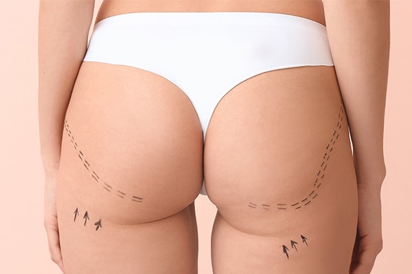 implants fessiers prothese fesse avant apres paris chirurgie des fesses fessier paris chirurgien esthetique plasticien paris dr sebastiano montoneri implants fessiers prothese fesse avant apres paris chirurgie des fesses fessier paris chirurgien esthetique plasticien paris dr sebastiano montoneri