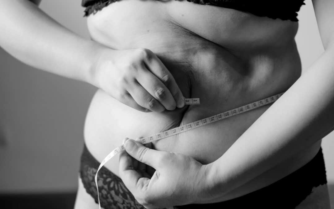 Dans quel cas avoir recours à une abdominoplastie ?