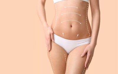 Dans quels cas avoir recours à une abdominoplastie ou une liposuccion ?