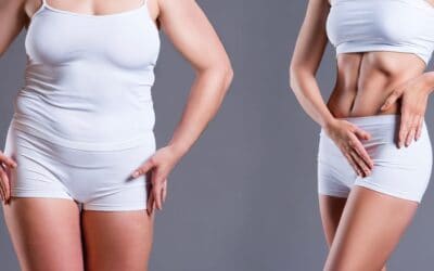 Abdominoplastie : à quel résultat s’attendre ?