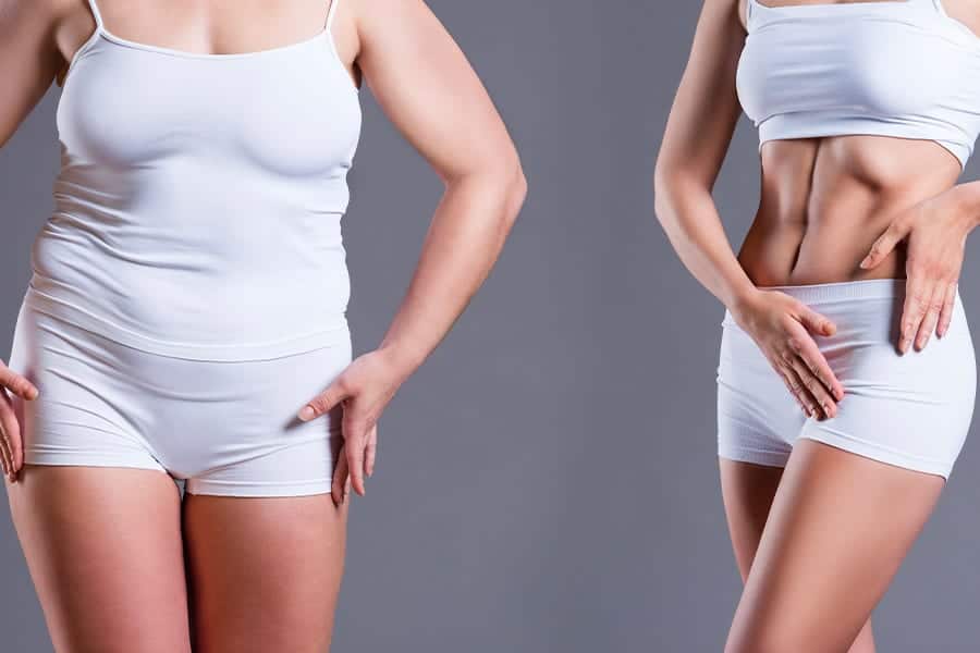 Abdominoplastie : à quel résultat s’attendre ?