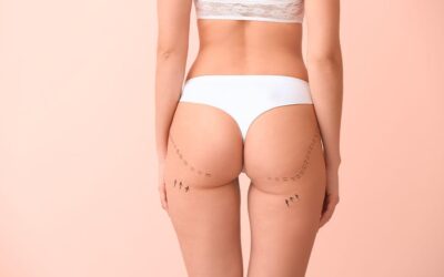 Implant fessier ou lipofilling des fesses : quelle différence ?